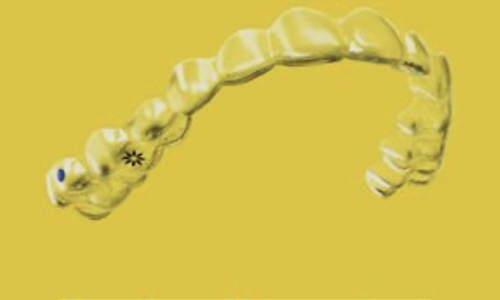 Invisalign